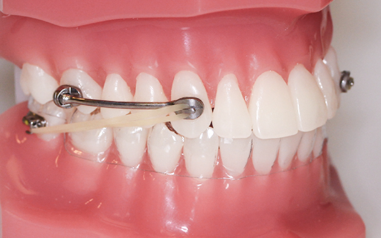 Carriere Appliance | Effective Orthodontic Treatment