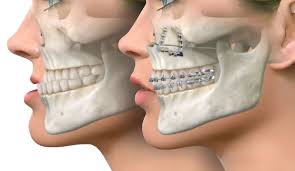 Jaw Surgery - O2 Dental
