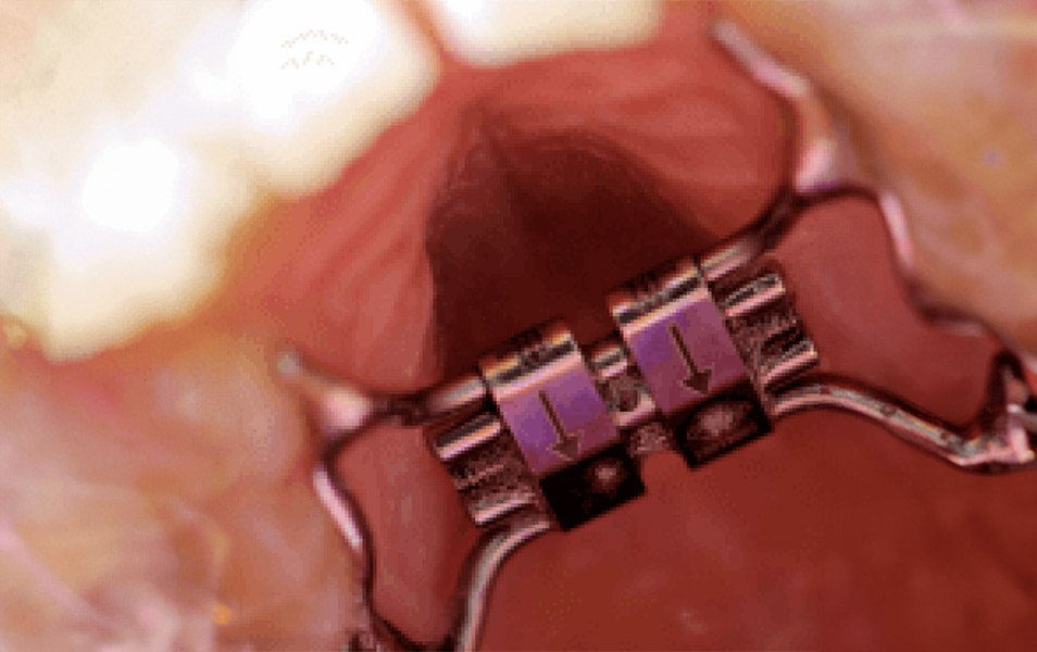 Palatal Expansion | Orthodontic Treatment, Vancouver BC