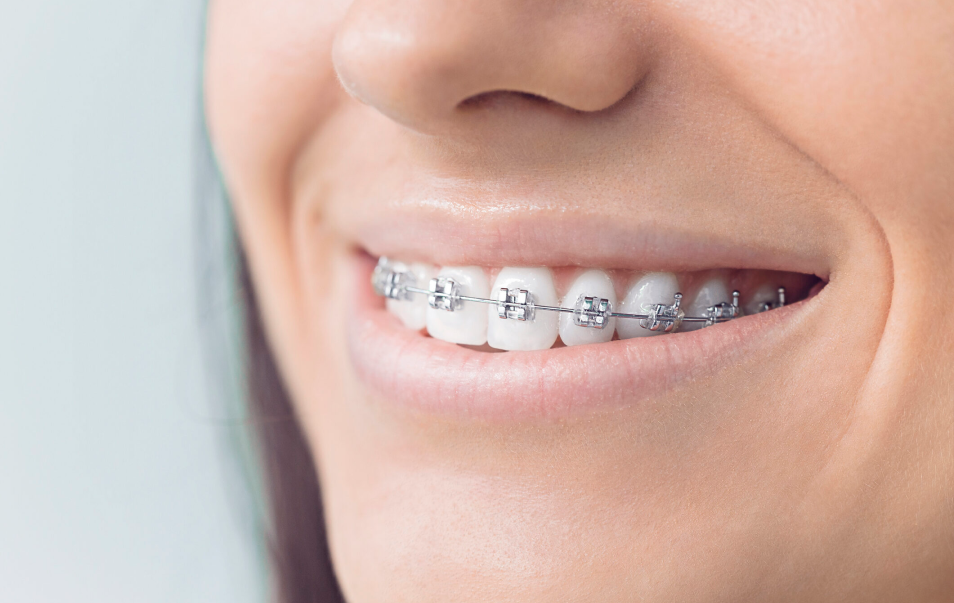 Transform Your Smile with Braces - O2 Dental