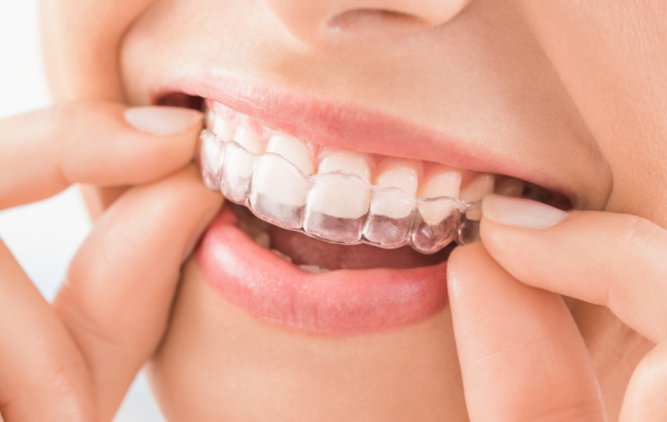 Invisalign® in Vancouver, BC ​