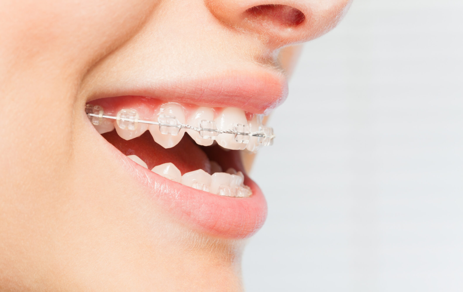 LightForce Braces in Vancouver – O2 Dental Orthodontics