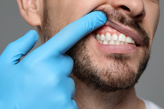 Gum Graft Treatment in Vancouver – O2 Dental