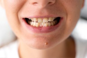 o2dental-Dentist-near-me-Gum-Disease