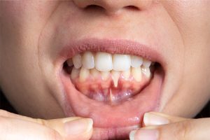 Advanced gum recession exposing tooth roots – causes of gum recession