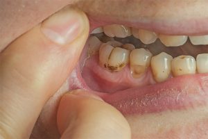 Plaque Between Teeth