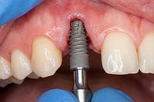 Close-up view of a patient undergoing dental implants surgery at O2 dental Vanocuver, showing the realistic placement of dental impants.